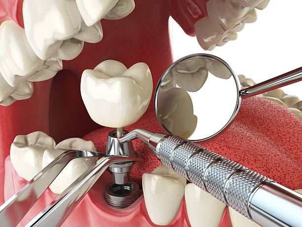 Best Emergency Tooth Extraction in Coldstream, OH